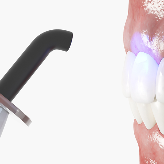 Illustration of light hardening material on teeth for cosmetic bonding