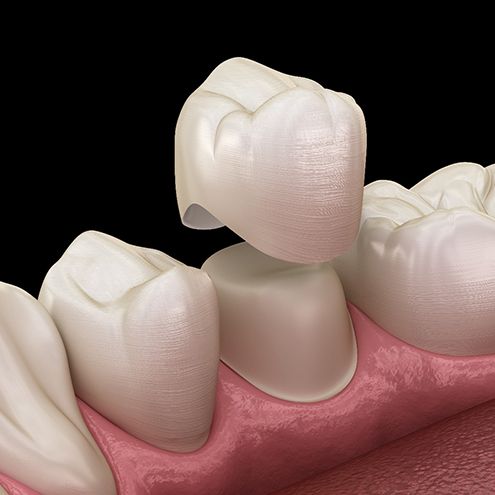 What Is a Dental Crown?