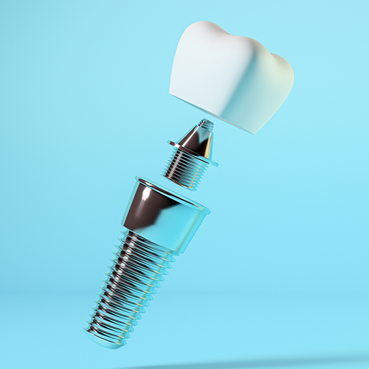 Dental implant in Melbourne with crown and abutment