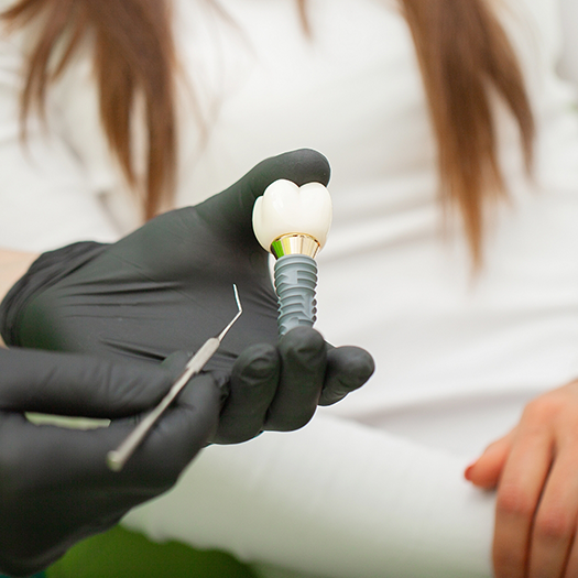 Gloved hand holding a dental implant