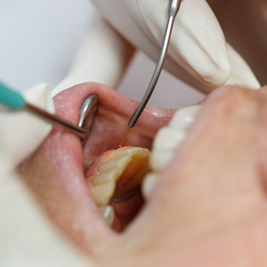 Pulling back patient's lips with dental mirror to treat gums with a laser