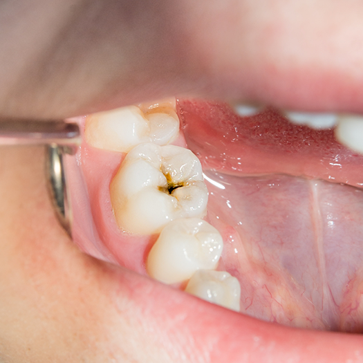 Pulling on patient's lip to show decayed tooth