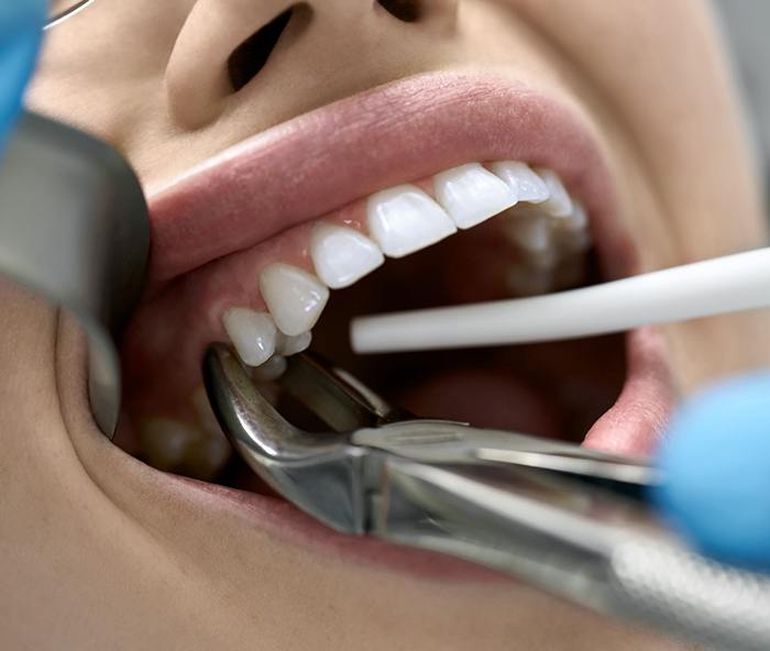  Closeup of a mouth with forceps grasping a tooth