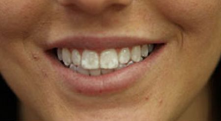 Dull discolored teeth before treatment