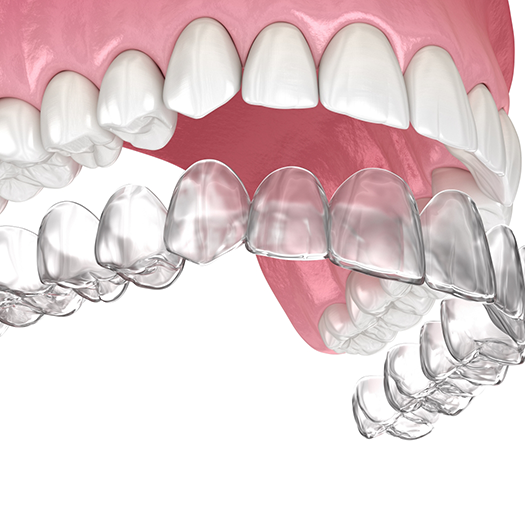 Clear aligners being placed on upper teeth