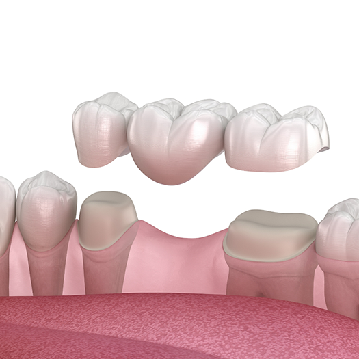 Illustration of dental bridge being attached to lower teeth