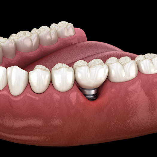 Illustration of dental implant in lower arch
