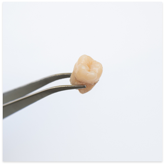 Extracted tooth held by metal dental instrument