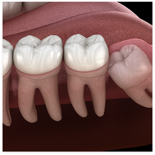 Illustration of impacted wisdom tooth pressing against other teeth