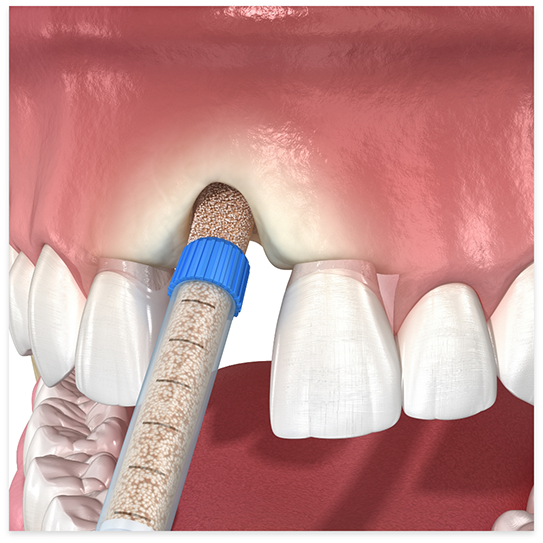 Bone grafting being performed in upper arch