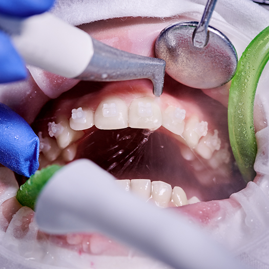 Patient's teeth being cleaned for preventive dentistry in Melbourne