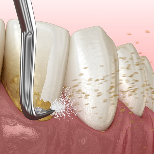 Illustration of scaling and root planing performed on lower teeth