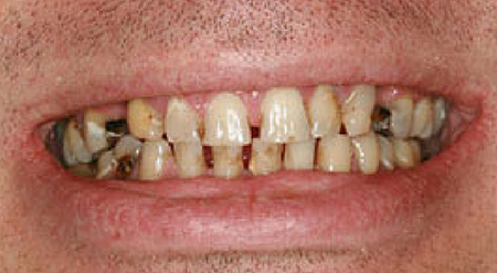 Smile with multiple decayed and discolored teeth