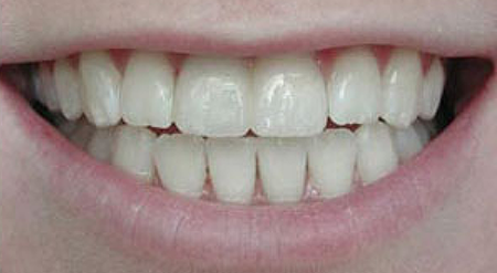 Smile after missing tooth has been replaced