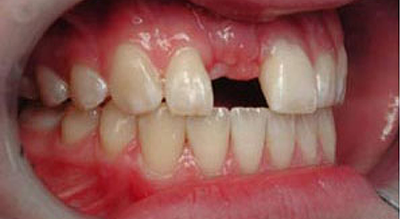 Smile with a missing tooth