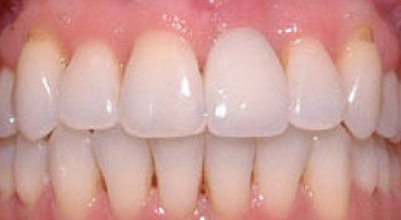 Smile with properly aligned teeth