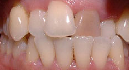 Smile with multiple misaligned teeth