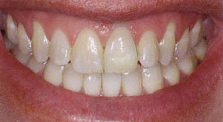 Smile with whitened front tooth