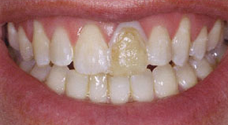 Smile with notably yellowed front tooth