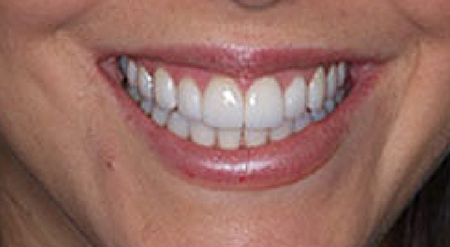 Bright smile after treatment
