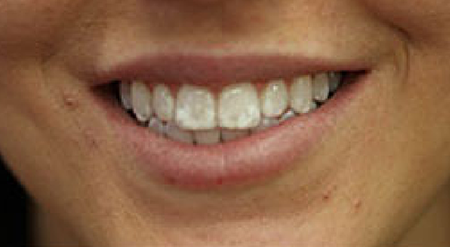 Smile with spots on teeth